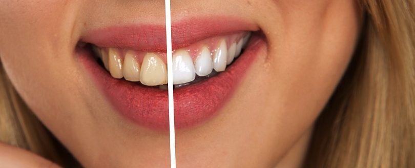 The Many Benefits Of Laser Teeth Whitening