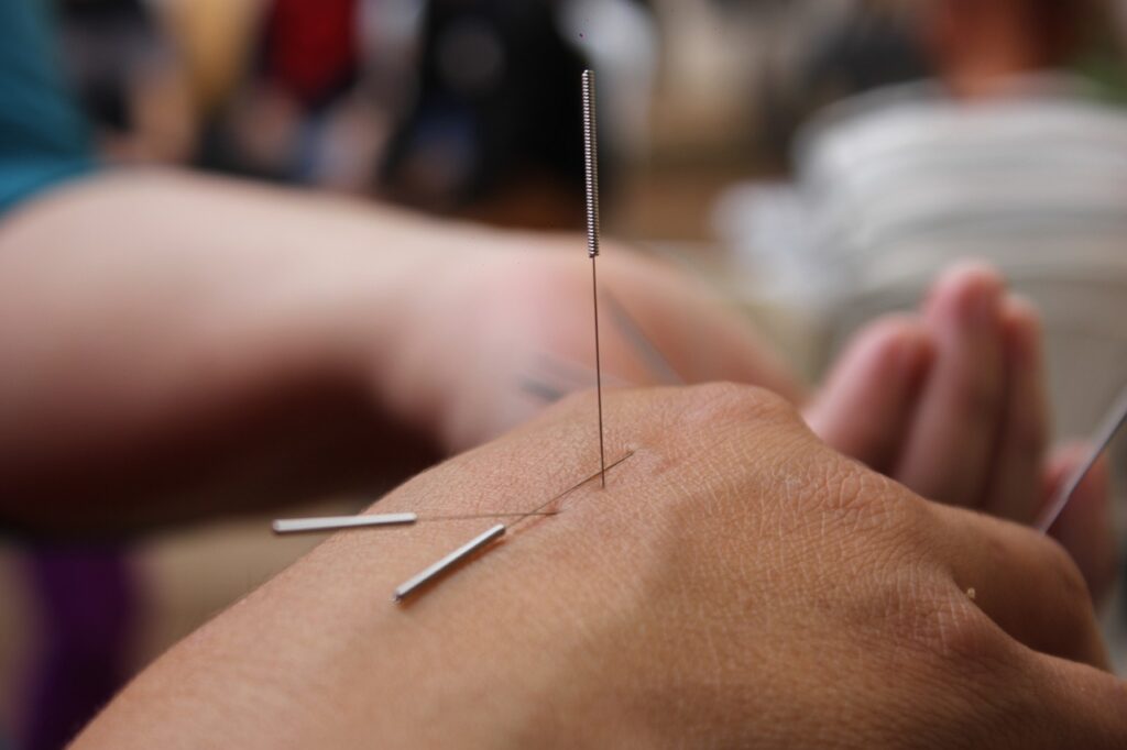 Traditional Chinese Medicine Acupuncture: A Comprehensive Guide