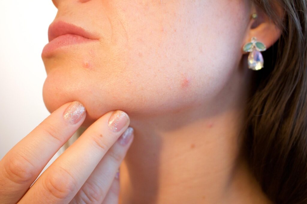 Say Goodbye to Those Pesky Scars: Effective Treatments for Acne Scarring